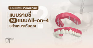เปรียบเทียบรากเทียมแบบรายซี่ vs แบบ All-on-4: อะไรเหมาะกับคุณ