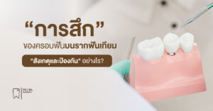 การสึกของครอบฟันบนรากเทียม สังเกตและป้องกันอย่างไร