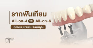 รากฟันเทียม All-on-4 vs All-on-6 เลือกแบบไหนเหมาะกับคุณ