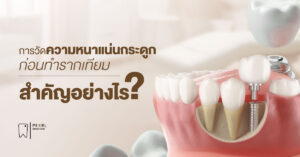 การวัดความหนาแน่นกระดูกก่อนทำรากฟันเทียม สำคัญอย่างไร