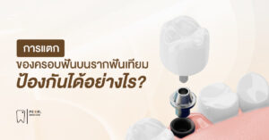 การแตกของครอบฟันบนรากฟันเทียม ป้องกันได้อย่างไร