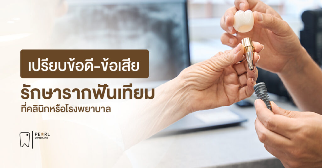 เปรียบข้อดี-ข้อเสีย รักษารากฟันเทียมที่คลินิกหรือโรงพยาบาล