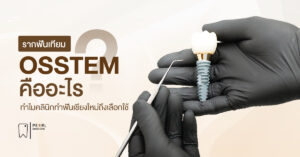 รากฟันเทียม Osstem คืออะไร ทำไมคลินิกทำฟันเชียงใหม่ถึงเลือกใช้