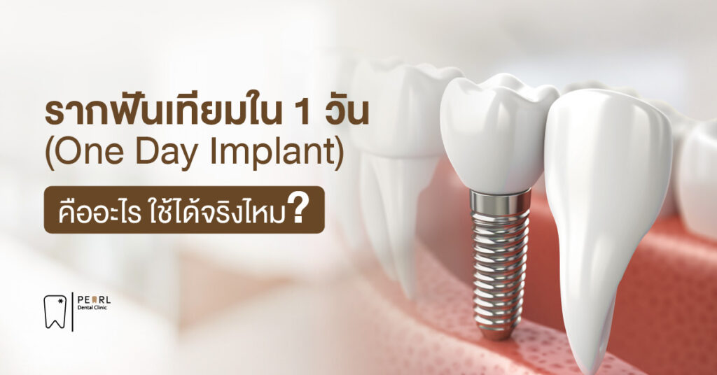 รากฟันเทียมใน 1 วัน (One Day Implant) คืออะไร ใช้ได้จริงไหม