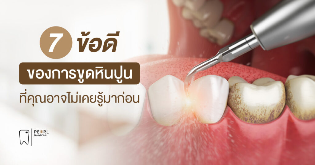 7 ข้อดีของการขูดหินปูน ที่คุณอาจไม่เคยรู้มาก่อน