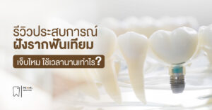 รีวิวประสบการณ์ฝังรากฟันเทียม เจ็บไหม ใช้เวลานานเท่าไร