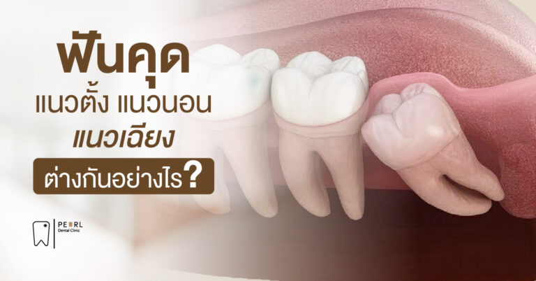 ฟันคุดแนวตั้ง แนวนอน แนวเฉียง ต่างกันอย่างไร