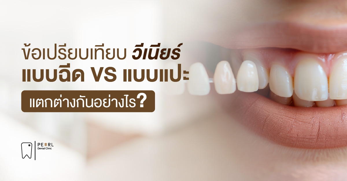 ข้อเปรียบเทียบวีเนียร์ แบบฉีด VS แบบแปะ แตกต่างกันอย่างไร