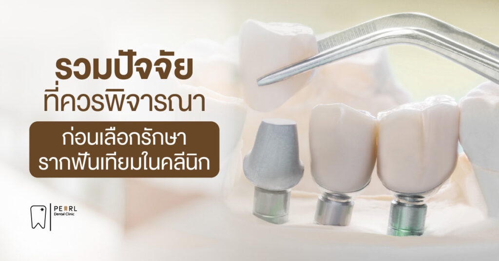 รวมปัจจัยที่ควรพิจารณาก่อนเลือกรักษารากฟันเทียมในคลินิก