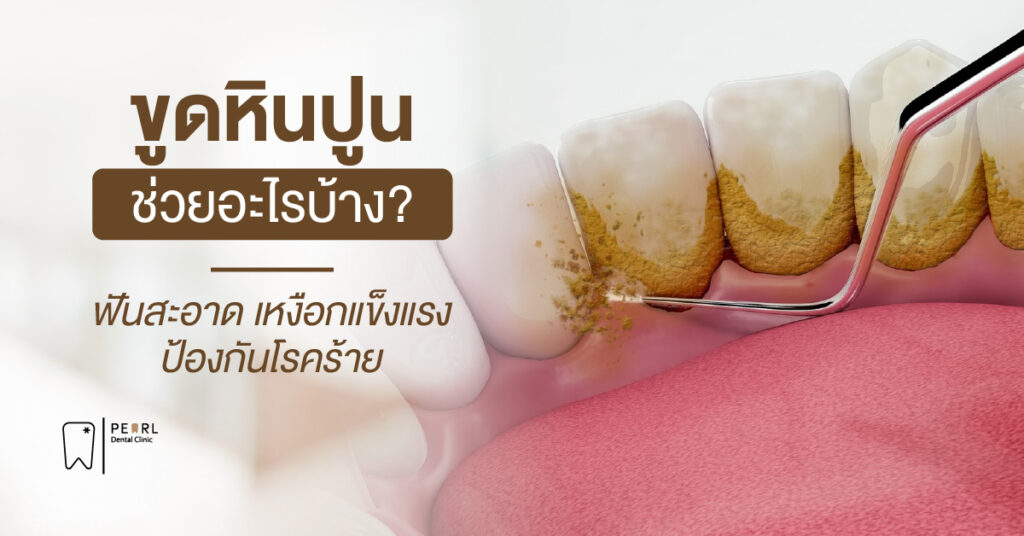 ขูดหินปูนช่วยอะไรบ้าง? ฟันสะอาด เหงือกแข็งแรง ป้องกันโรคร้าย