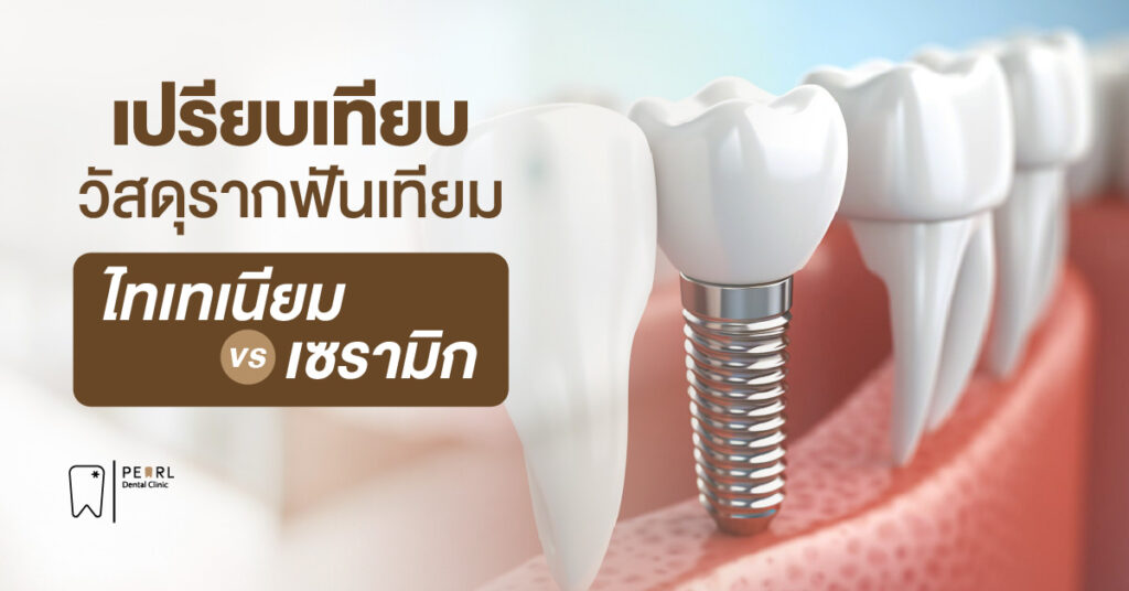 เปรียบเทียบวัสดุรากฟันเทียม ไทเทเนียม vs เซรามิก