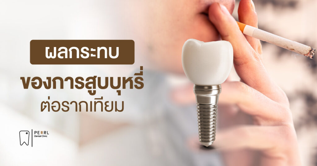 ผลกระทบของการสูบบุหรี่ต่อรากเทียม