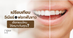 เปรียบเทียบ “วีเนียร์” vs “ฟอกฟันขาว” เลือกแบบไหนให้เหมาะกับคุณ