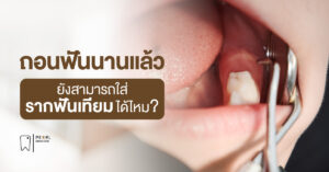 ถอนฟันนานแล้ว ยังสามารถใส่รากฟันเทียมได้ไหม?